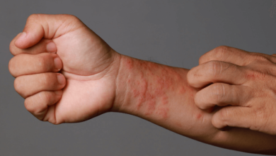 Managing Eczema: Symptoms, Triggers, and Treatment Options